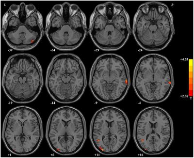 Associations between abnormal spontaneous neural activity and clinical variables, eye movements, and event-related potential indicators in major depressive disorder